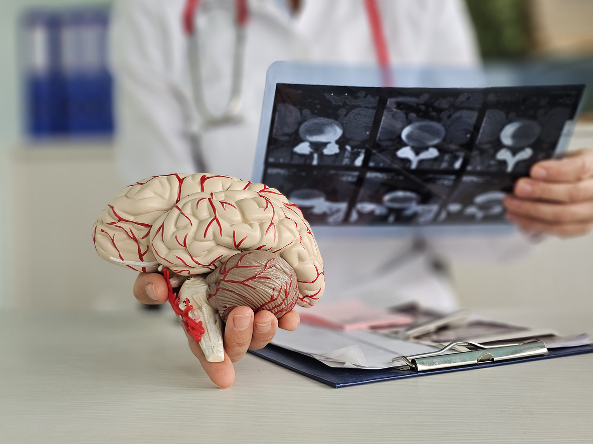 Pesquisadores do Baylor College of Medicine identificam como o Candida albicans pode gerar proteínas semelhantes ao beta amilóide no cérebro, um fator chave do Alzheimer.