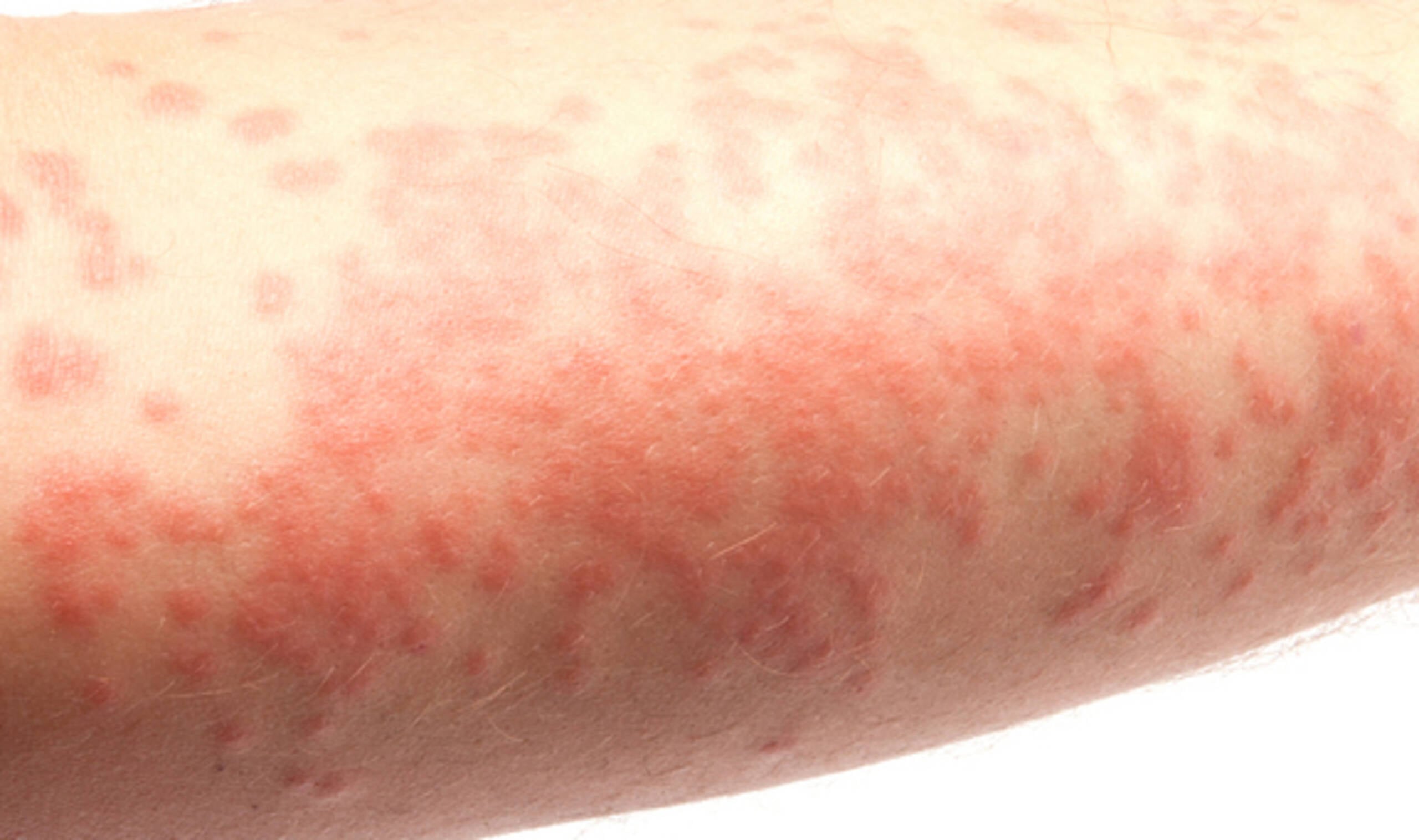 Conheça a Síndrome de Stevens-Johnson (SSJ)