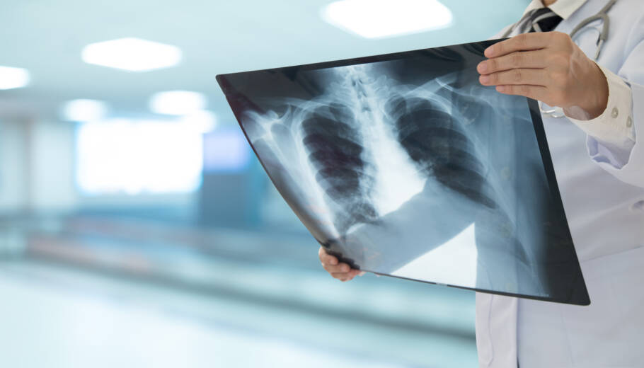 Tosse persistente e dificuldade para respirar podem ser sinais de câncer de pulmão. Fique atento aos sintomas!