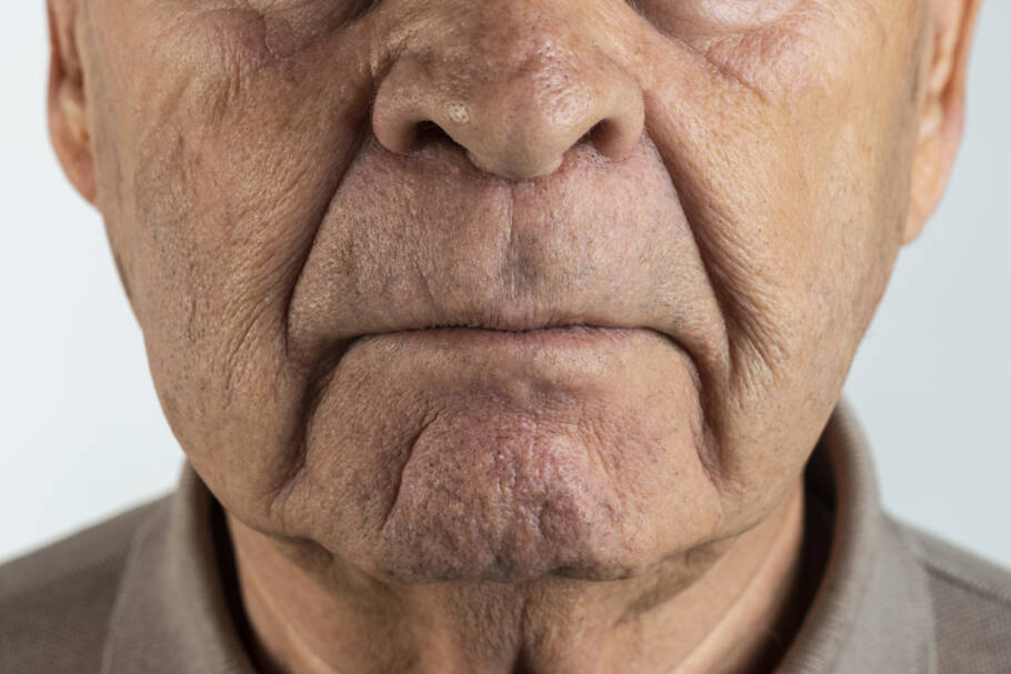 Embora possa ser visto como um sintoma “oculto” do Parkinson, a perda de olfato pode ter um impacto profundo