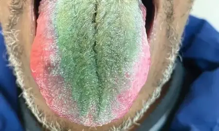 Alterações na língua podem ser o primeiro sinal de doenças que precisam de diagnóstico rápido.