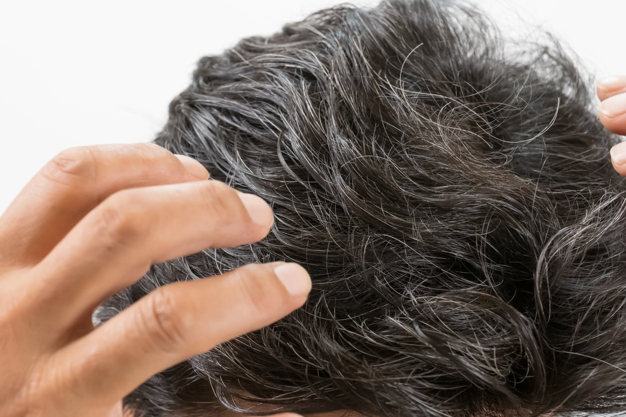 A chave para o embranquecimento dos fios está na produção de melanina — o pigmento natural responsável pela cor do cabelo – iStock/makotomo