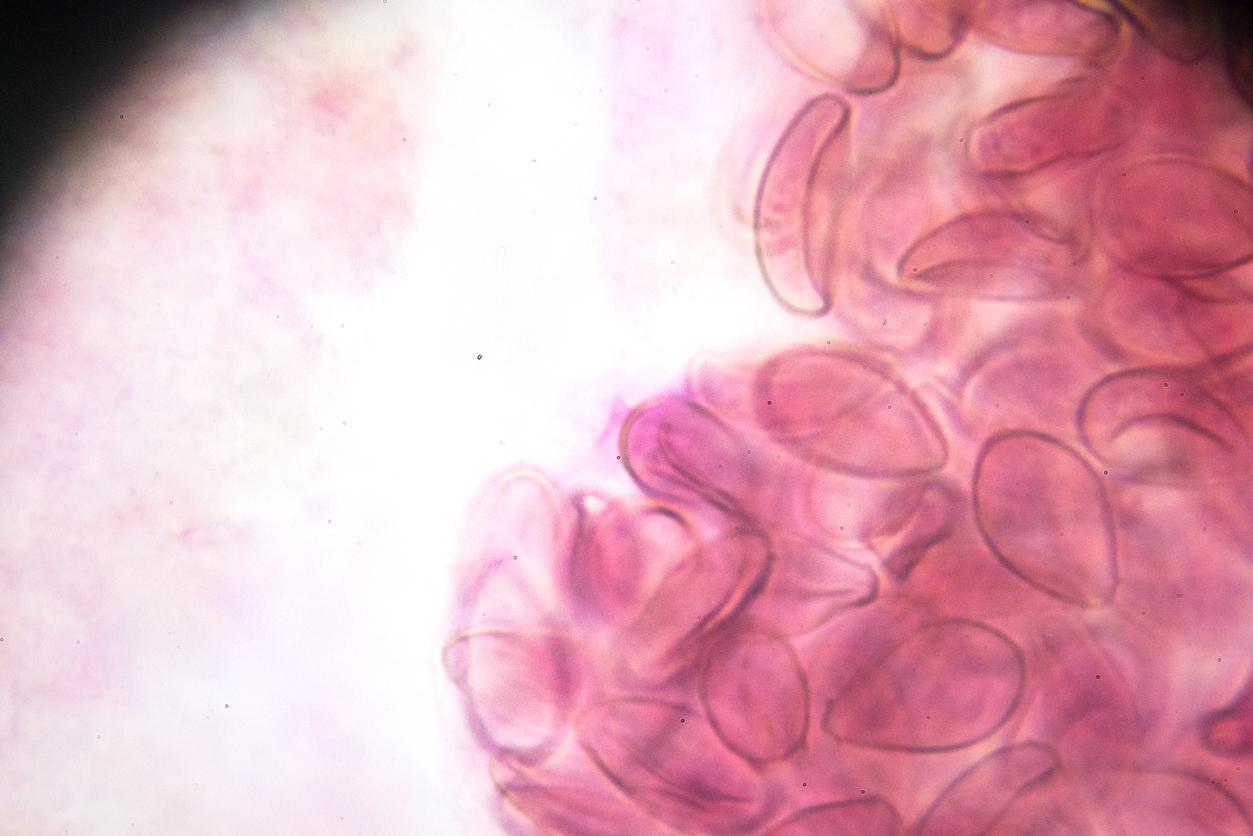 Aos 20 anos, Ben iniciou o uso de um medicamento que ajuda a controlar a inflamação causada pela GEE