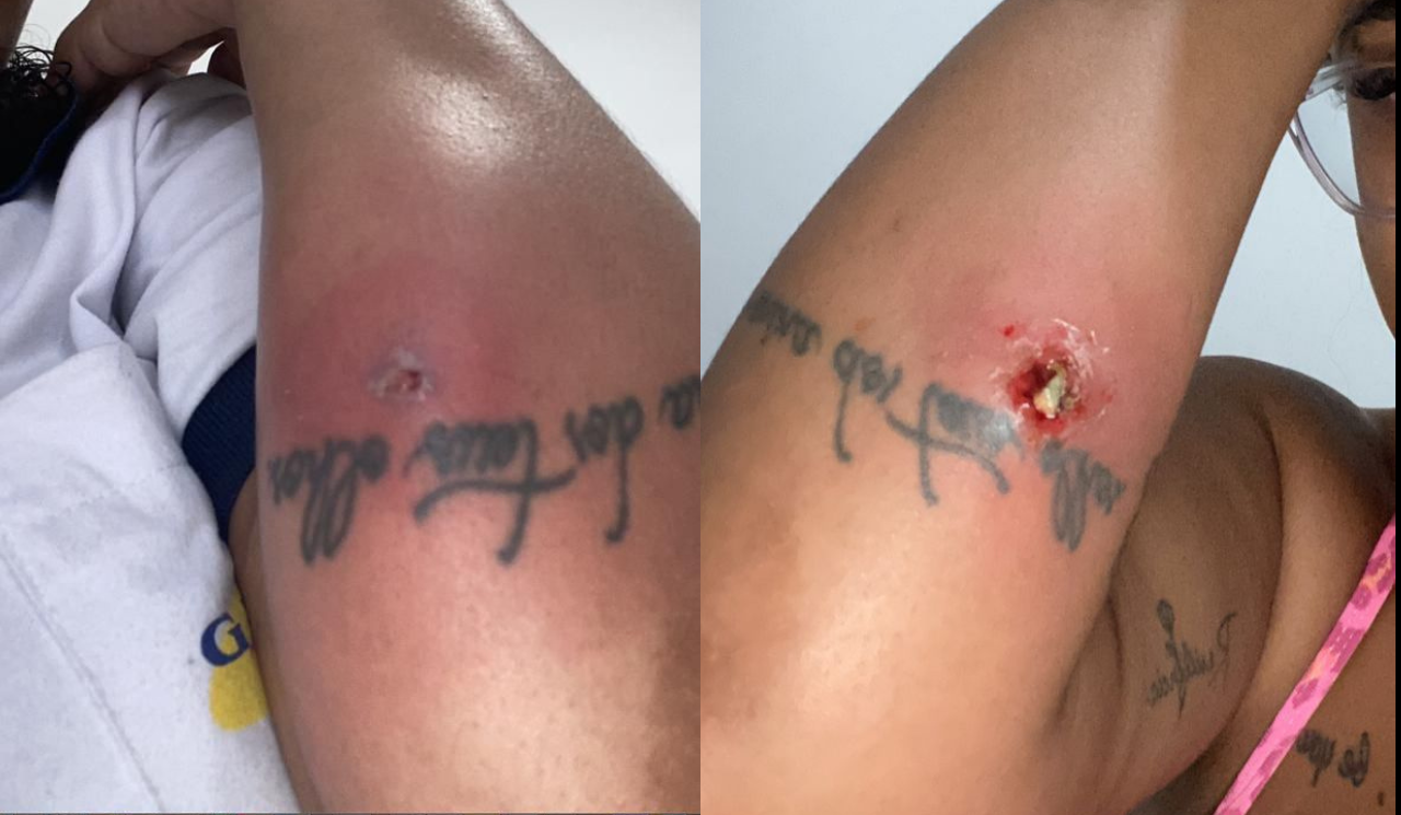 Ferida no braço esquerdo que parecia simples, mas deu início a uma grave infecção bacteriana.