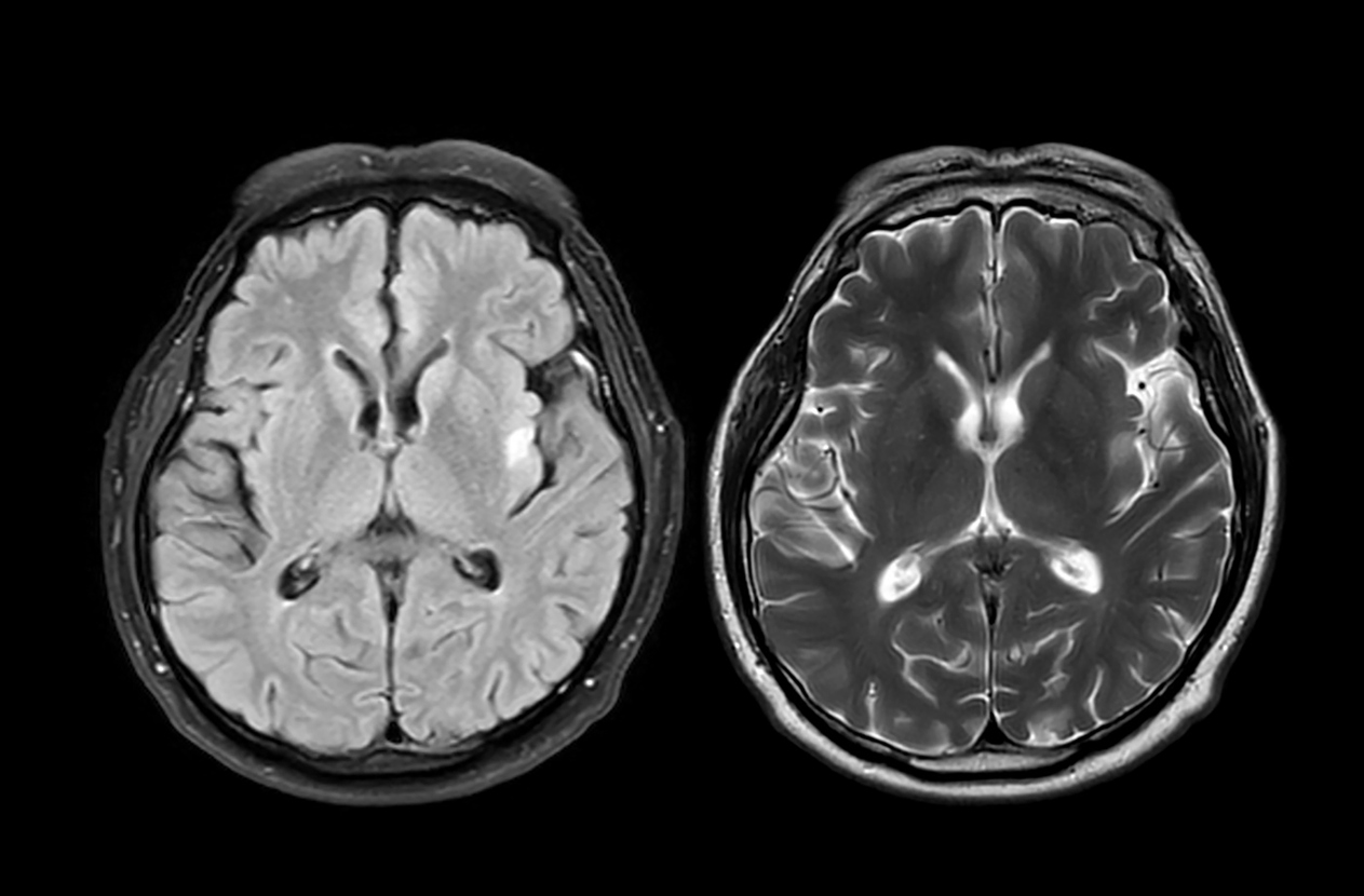 Cientistas descobriram um novo gatilho para o Alzh