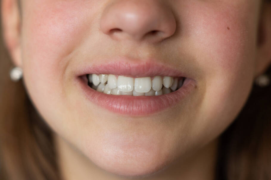 Alimentos ácidos podem acelerar o desgaste do esmalte dos dentes e favorecer inflamações gengivais