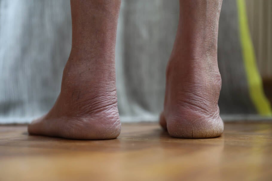 Pés inchados podem indicar insuficiência cardíaca