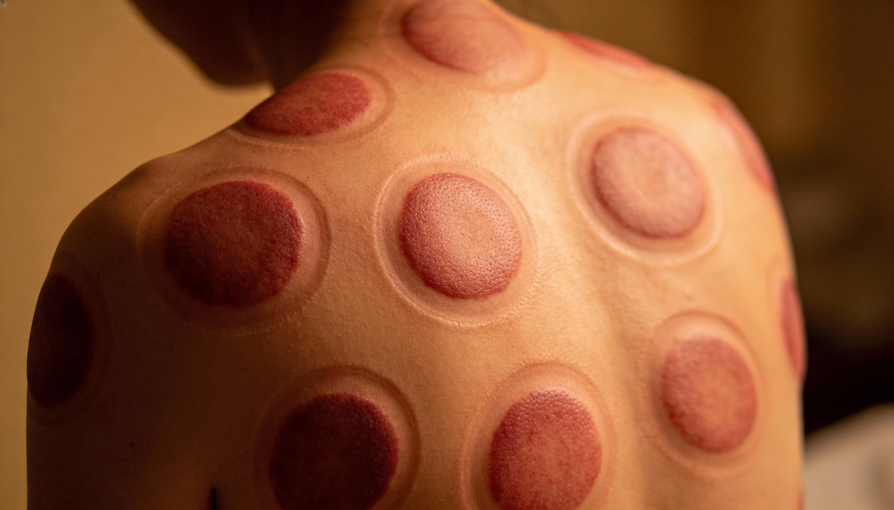 As manchas que aparecem após o uso das ventosas são causadas pelo aumento do fluxo de sangue na superfície da pele durante a sucção