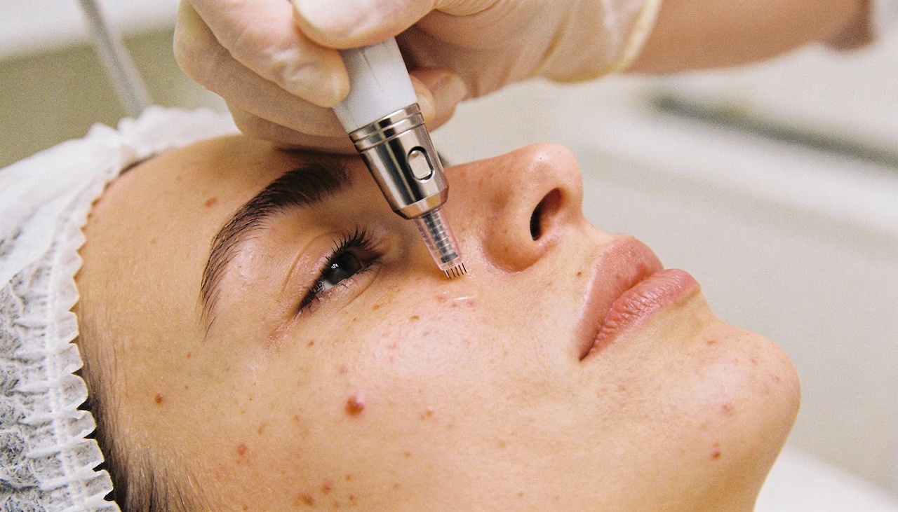 O microagulhamento utiliza um dispositivo com microagulhas esterilizadas para criar pequenas perfurações controladas na pele
