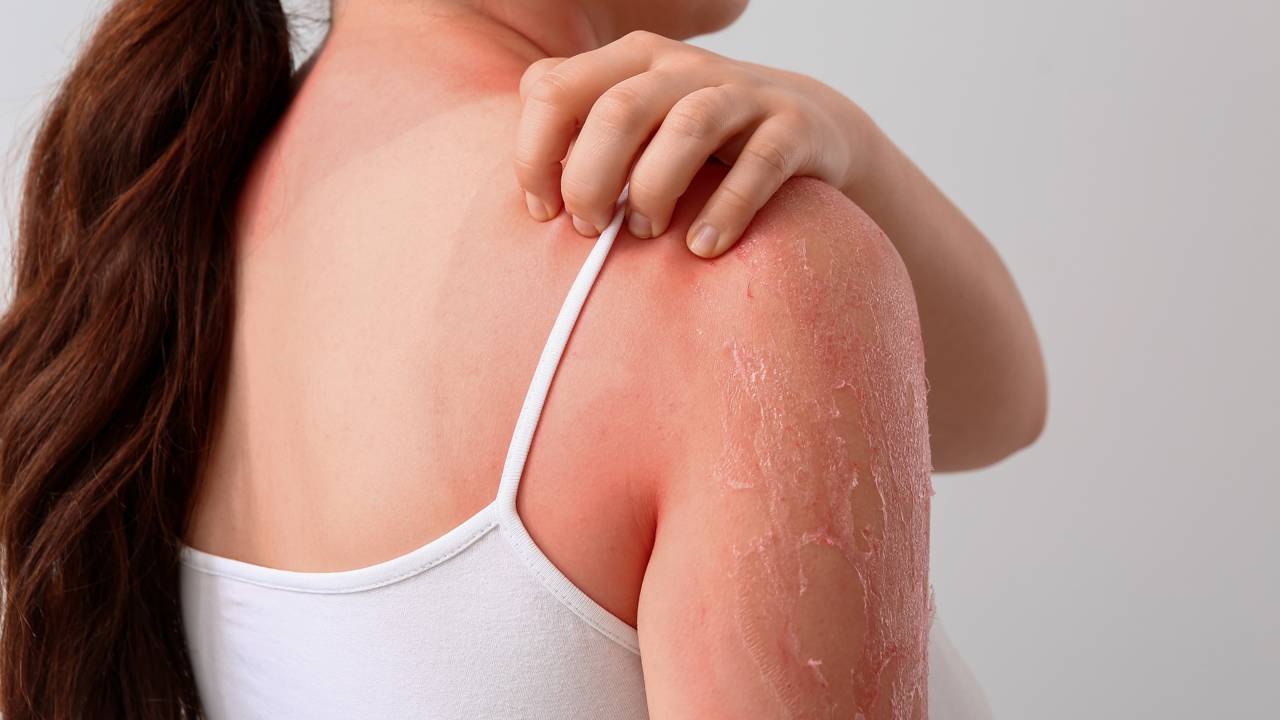 Exagerou no sol ou usou o creme errado? Entenda o que significa a pele descamando e como devolver a proteção natural sem causar mais manchas.