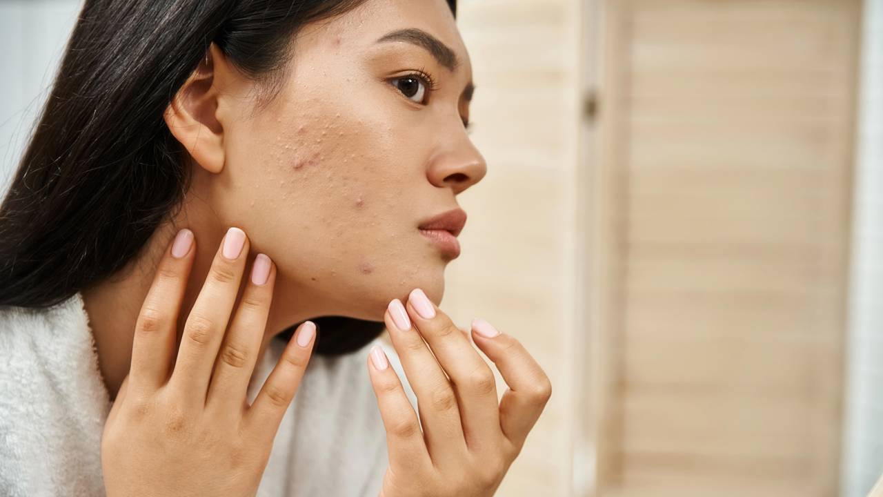 Guia rápido: controle a acne em 2 minutos. Saiba quais produtos evitar e como lavar o rosto corretamente para reduzir inflamações de imediato.