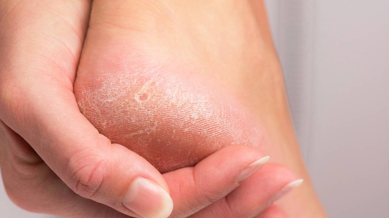 Passo a passo: como usar bicarbonato de sódio para remover calosidades de forma segura e natural.