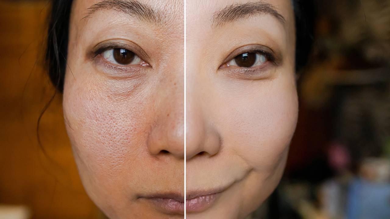 Clareador caseiro ou estética profissional? Saiba quando as misturas naturais funcionam para marcas de acne e quando é hora de procurar uma clínica especializada para tratar o melasma.