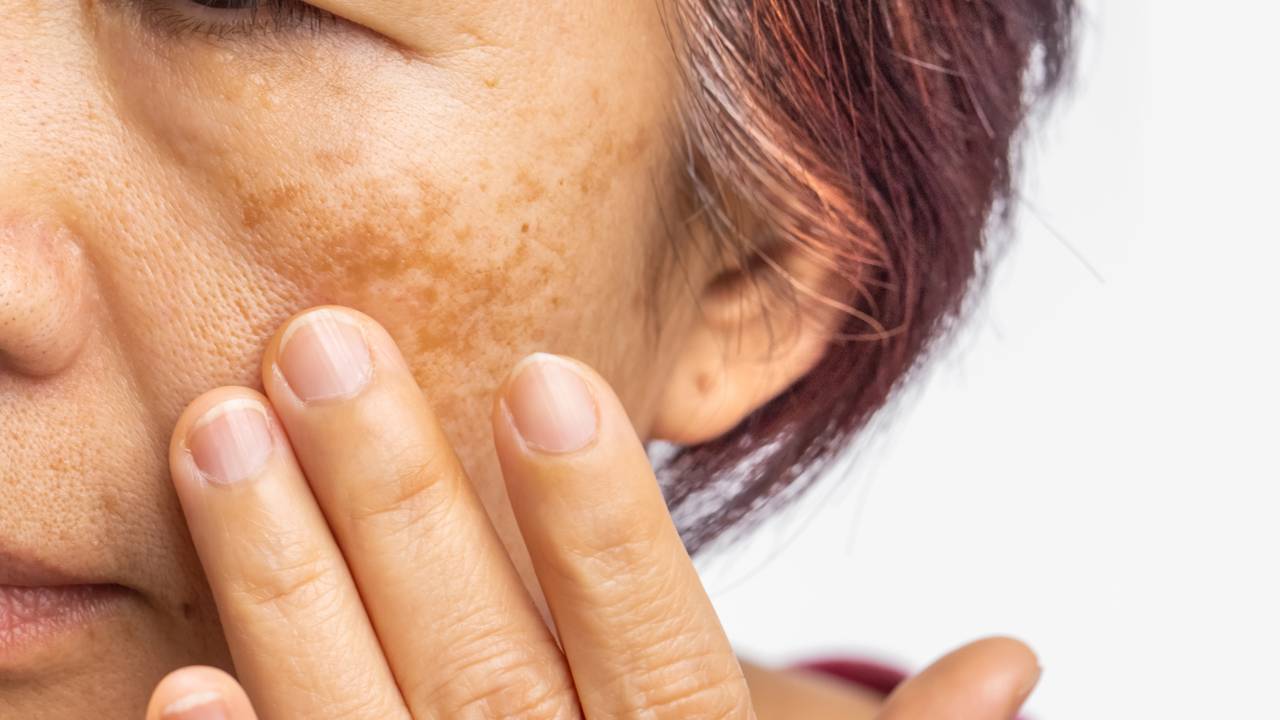 Quer saber qual o melhor custo-benefício para manchas na pele? Confira a tabela de preços 2026 para tratamentos de melasma e descubra quantas sessões são necessárias.