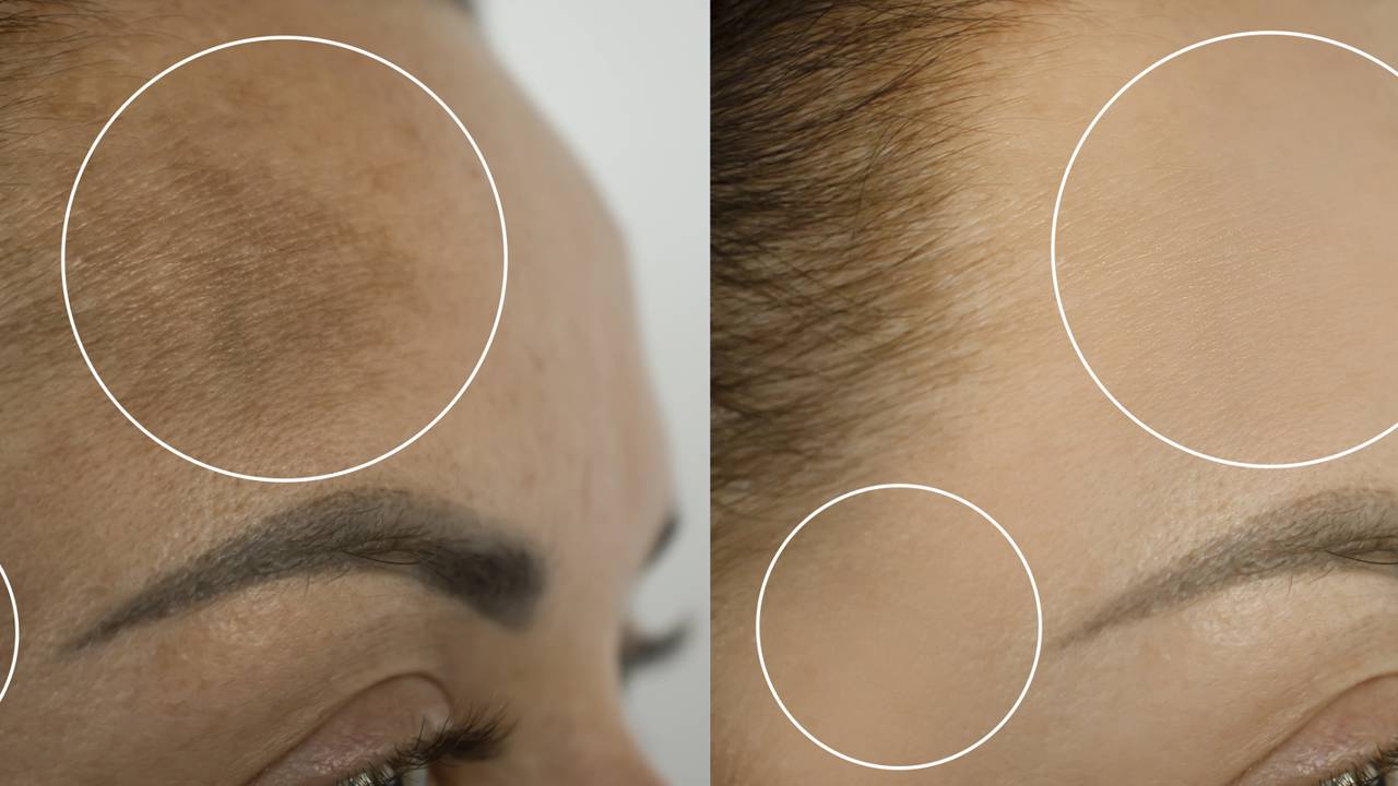 Pele luminosa e uniforme: veja por que a argila branca é a favorita para complementar o tratamento de manchas no rosto.