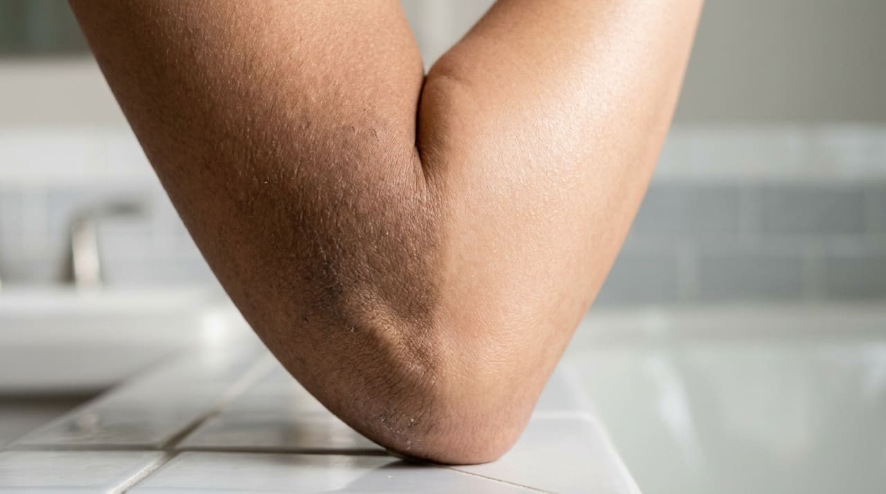 Os cotovelos fazem parte de uma área de grande movimento, onde a pele é mais grossa, sofre pressão e roça com mesas, roupas e outras superfícies.
