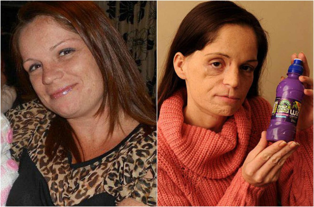 A britânica Lisa Epsom, de 34 anos, antes e depois da retirada de um tumor na boca