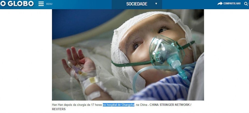 Menina sofria de hidrocefalia e tinha a cabeça quatro vezes maior que o tamanho normal (Reprodução/O Globo