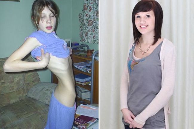 Anorexia: jovem que ficou uma semana sem comer vira vegana e conta sua  história de superação