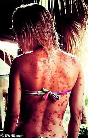 A doença é crônica, mas não contagiosa e surge principalmente entre os 30 e 50 anos de idade