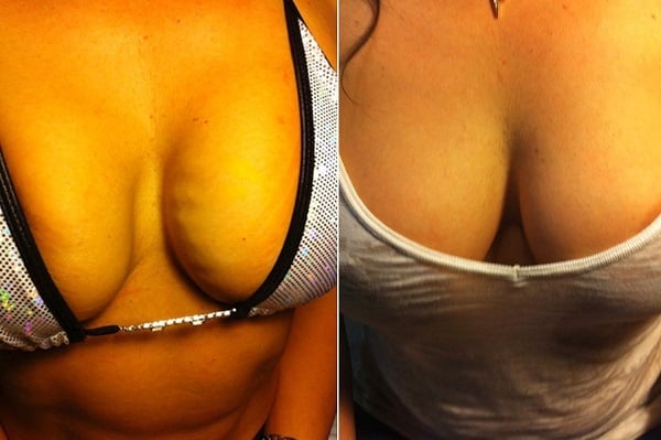 O método consiste em injetar sangue nos seios